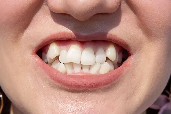Crooked or Crowded Teeth